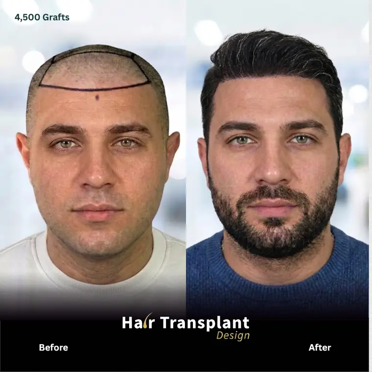 Before and after FUE hair transplant in Tampa: full frontal restoration with 4,500 grafts