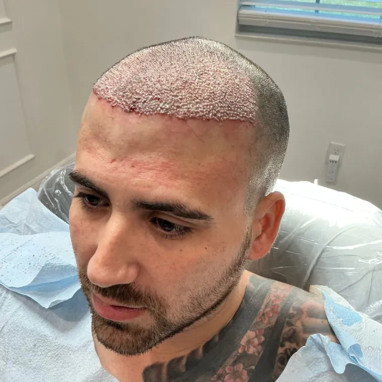 Front and mid-scalp restoration, the day of surgery, Hair Transplant Design Tampa