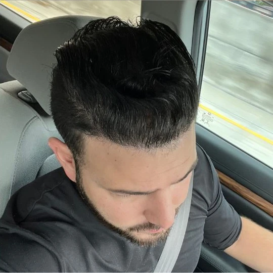 Super full hair restoration, after, styled, Hair Transplant Design Tampa