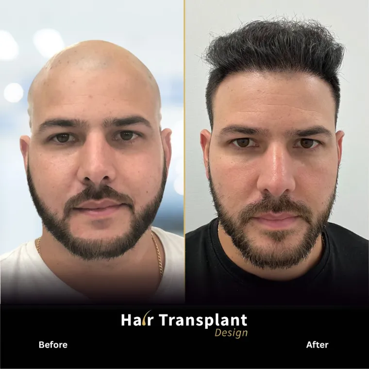 Before and after hair transplant in Tampa: full restoration with 5,500 grafts
