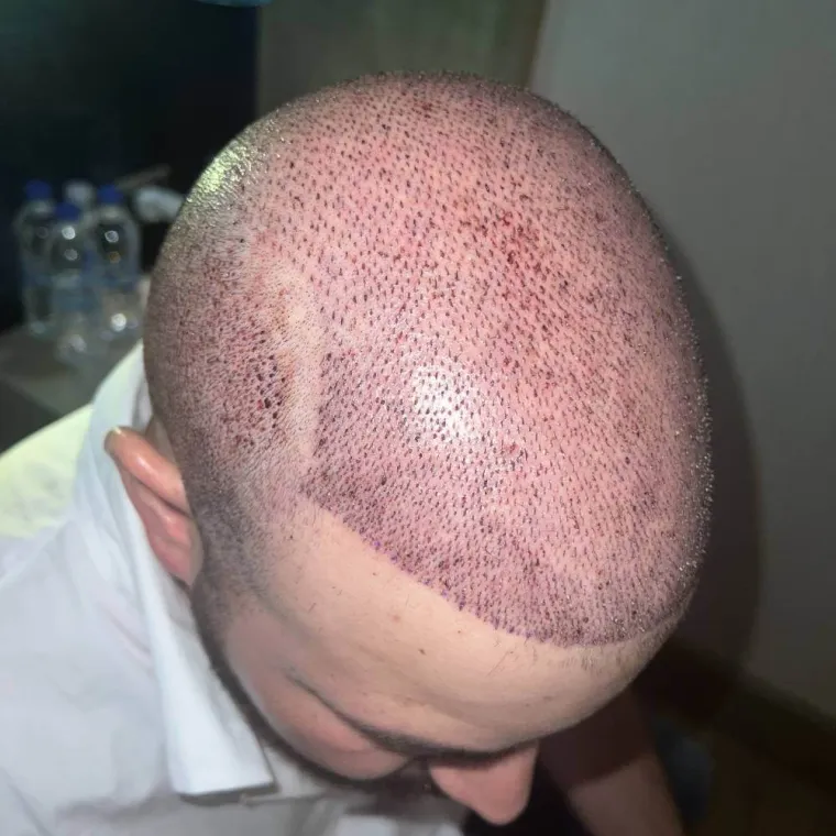 Super full hair restoration, the day of surgery, recipient area, Hair Transplant Design Tampa
