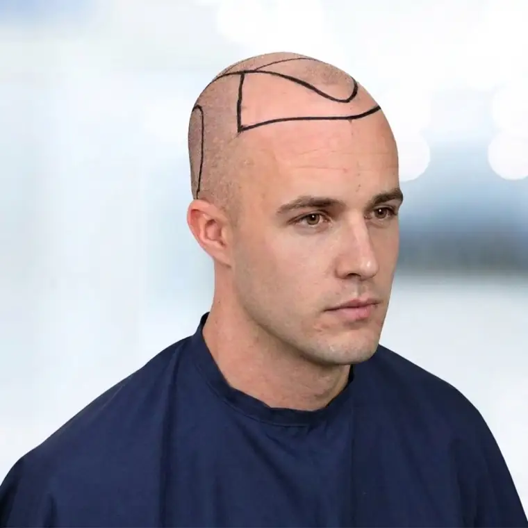 Surgical hairline design drawn on the patient before FUE extraction