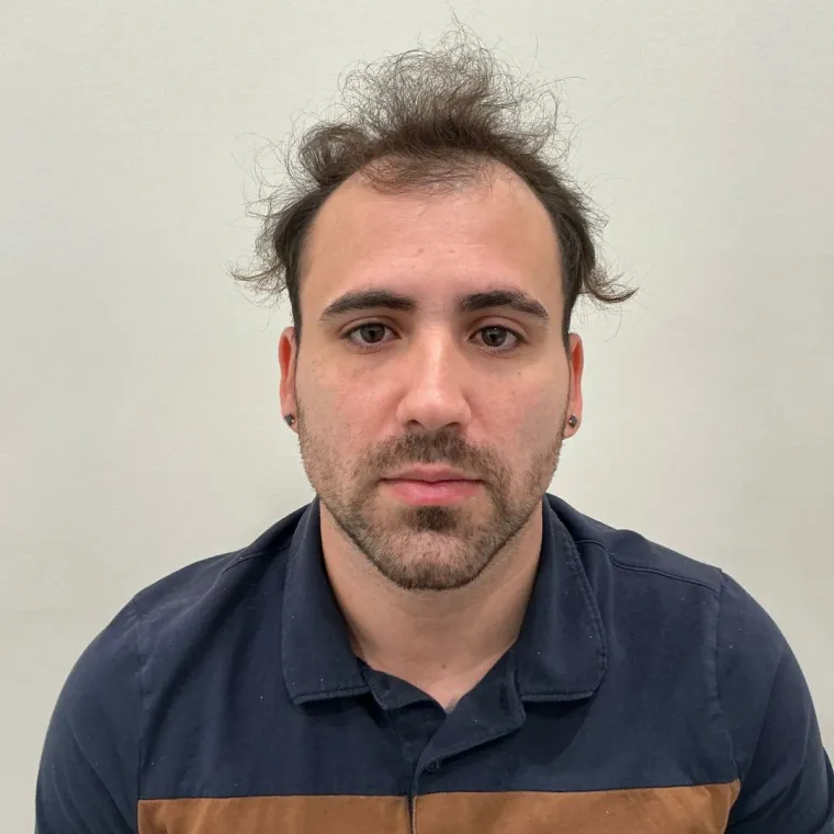 Restauración frontal y de zona media, antes, vista frontal, Hair Transplant Design Tampa