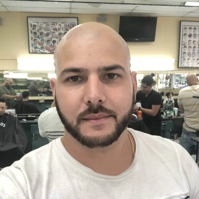 Restauración capilar súper completa, antes, Hair Transplant Design Tampa