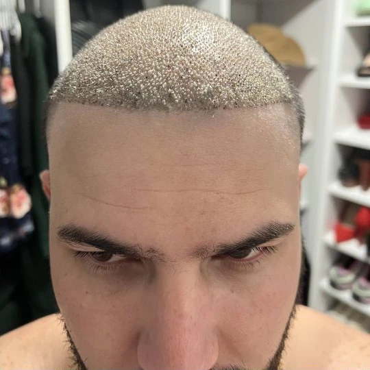 Restauración capilar súper completa, los primeros días, de frente, Hair Transplant Design Tampa