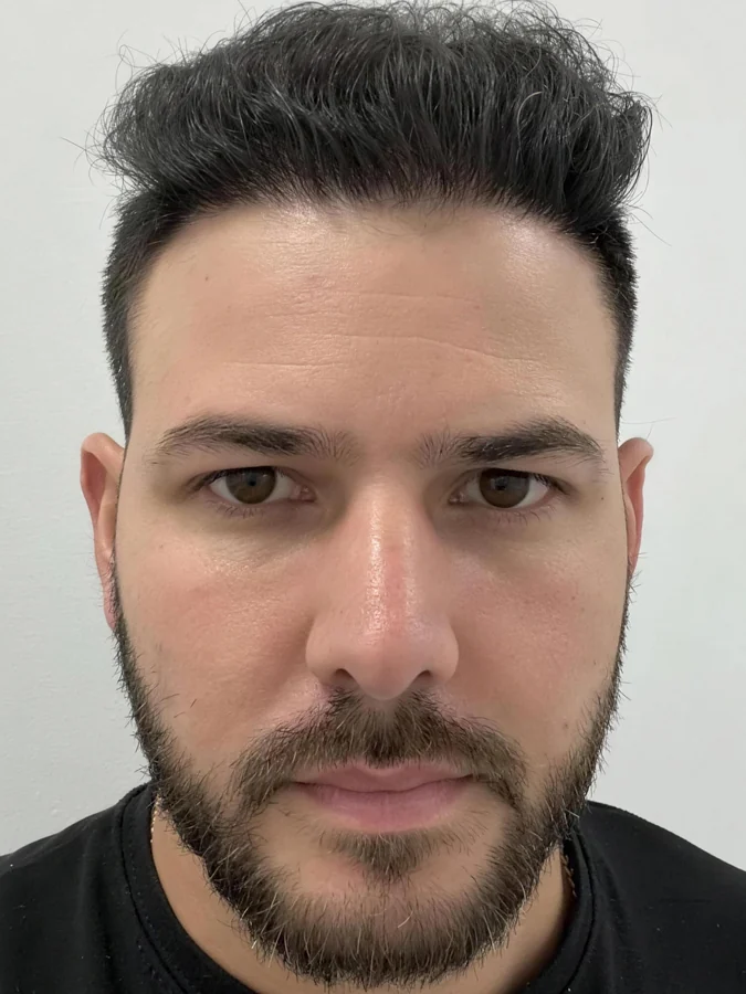Raúl después de 5,500 injertos en Hair Transplant Design: línea frontal completa y densidad