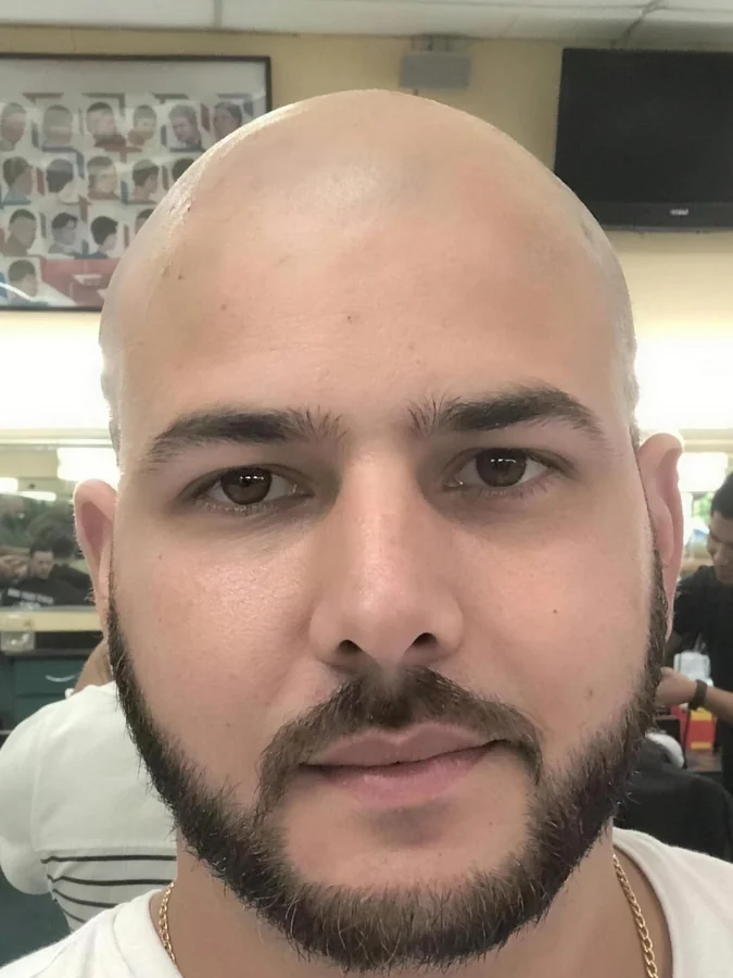 Raúl before his hair transplant, head shaved with advanced hair loss