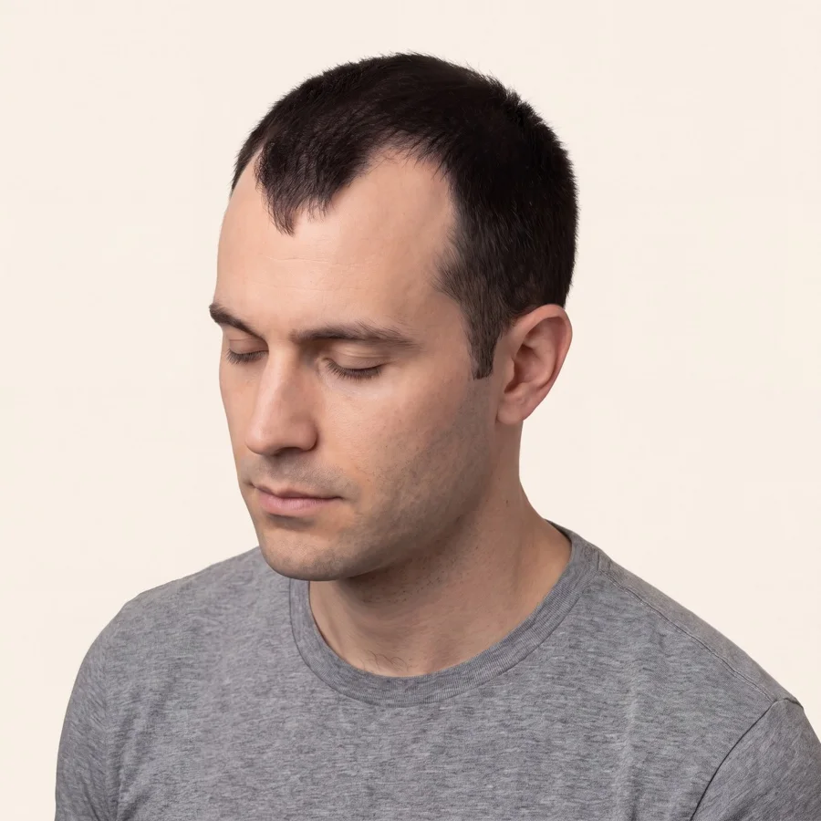 Medical illustration of Norwood stage III male pattern hair loss on the same model, donor hair intact
